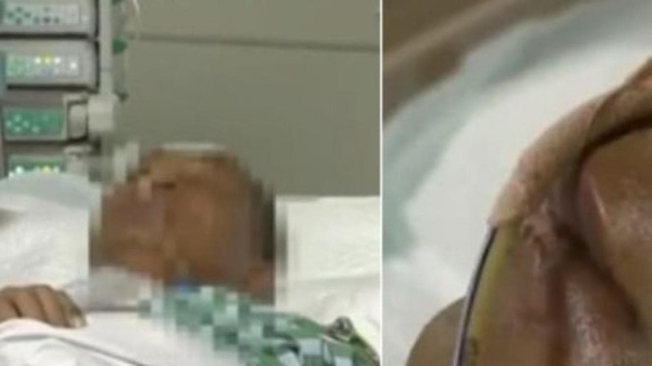 Pria ini Hampir Meninggal Gegara Pencet Jerawat (Foto:Istimewa)