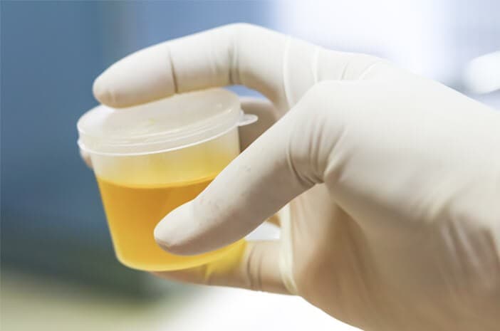 Ilustrasi  tes urine (Foto:Istimewa)