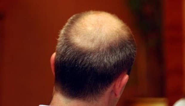 Ilustrasi rambut botak