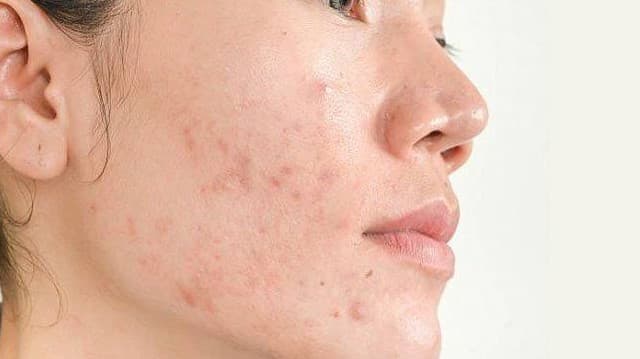 Baby Smooth Skin Dermapen