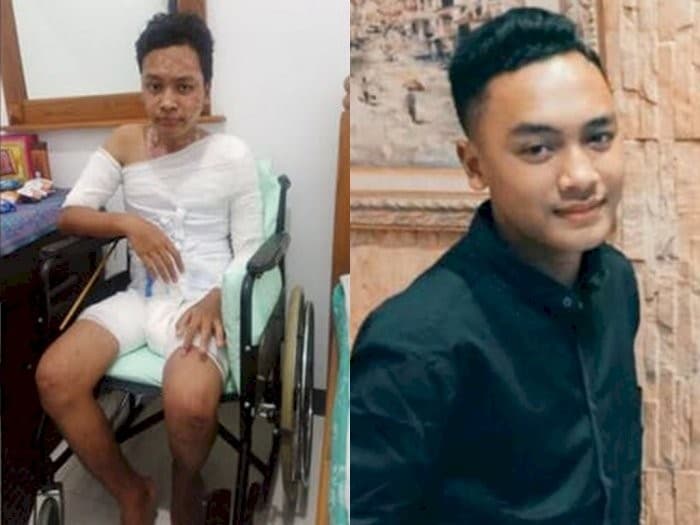 Malikul, santri asal Malang yang 70 persen tubuhnya alami luka bakar serius. 