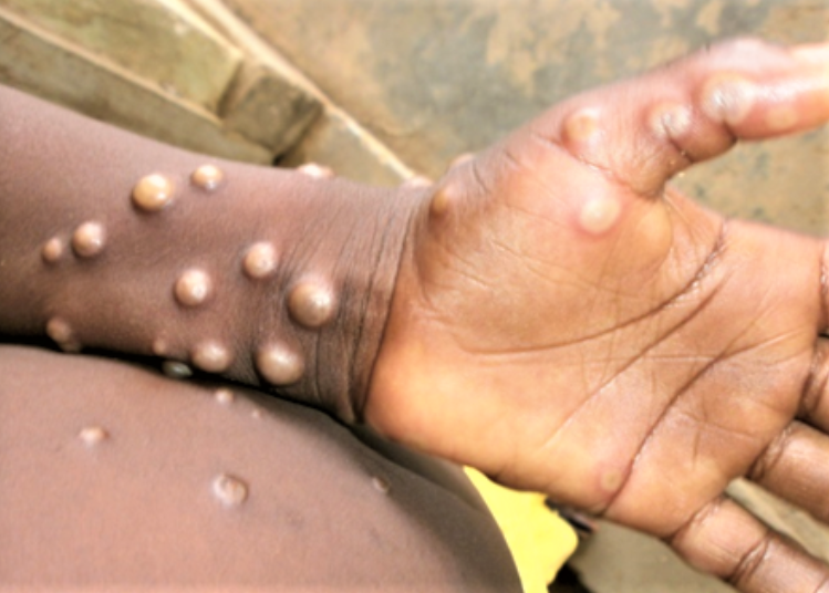 Ilustrasi cacar monyet atau monkeypox
