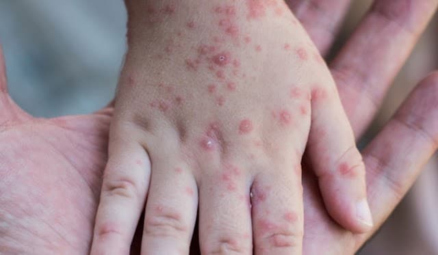 Ilustrasi rubella