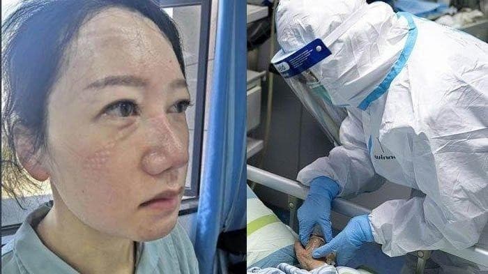 Penampakan wajah tenaga medis di Wuhan (Foto:Istimewa)