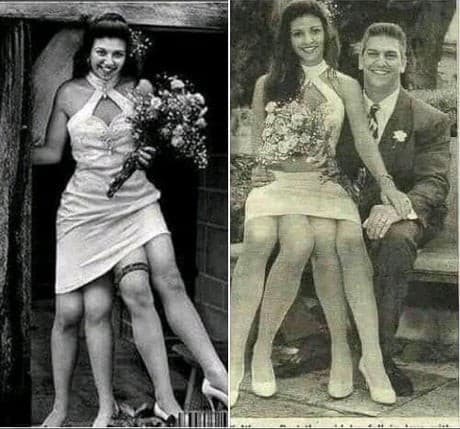 Lahir dengan kondisi medis dipygus,  Myrtle Corbin, memiliki 4 kaki  (Foto:Istimewa)