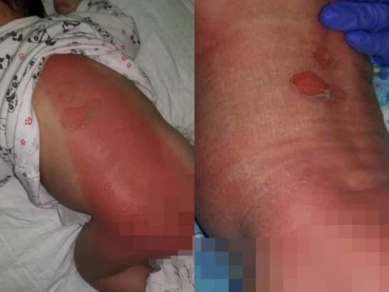 Kasihan! Ibu Ini Syok, Usai Dirawat Inap Bayinya Pulang dengan Luka Bakar Mengerikan di Tubuh