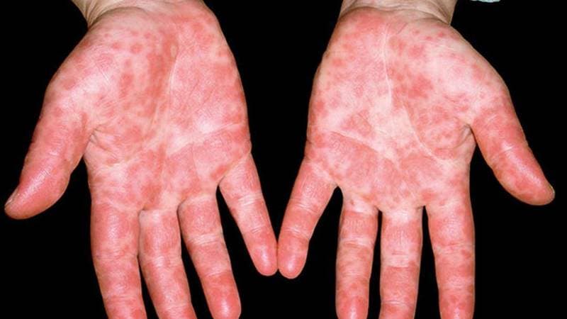 Flu Tomat Menyerang Anak-anak