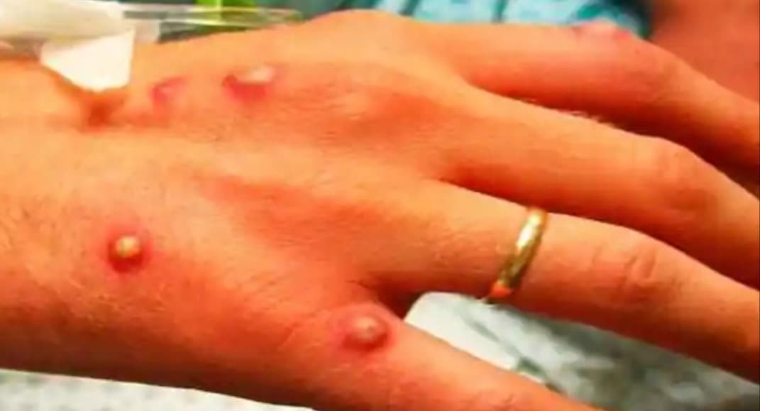 Vaksin Cacar Monyet Apakah Jadi Kewajiban Seperti Covid?