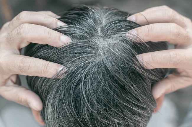 Misteri Uban pada Rambut Manusia Akhirnya Terkuak, Ilmuwan Temukan Fakta Ini