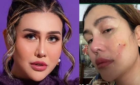 Pedangdut Ratu Meta Di-KDRT Suami.