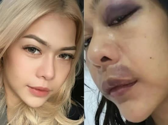 Selebgram Farah Diniarti Dianiaya Pacar hingga Babak Belur. (Foto: Instagram/@farahnunut_)