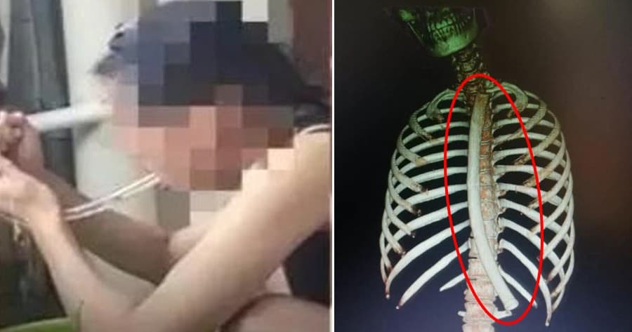 Wanita Ini Tak Sengaja Menelan Selang Berukuran 30 cm (Foto: Oriental Daily & China Press) Wanita Ini Tak Sengaja Menelan Selang Berukuran 30 cm (Foto: Oriental Daily & China Press)